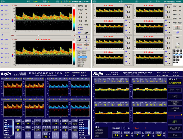 經顱多普勒檢查和頸動脈彩超有什么區別